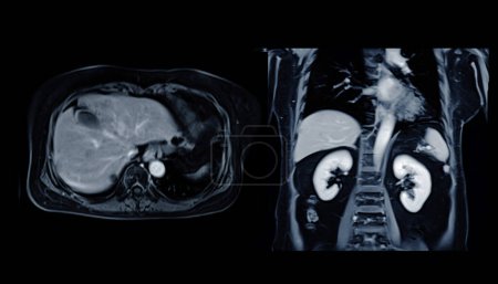 L'IRM de la vue coronale de l'abdomen supérieur est une technique d'imagerie non invasive fournissant des images détaillées d'organes comme le foie, le pancréas et les reins..