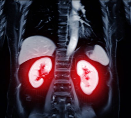 L'IRM de la vue coronale de l'abdomen supérieur est une technique d'imagerie non invasive fournissant des images détaillées d'organes comme le foie, le pancréas et les reins..