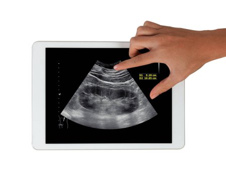 En una tableta sobre un fondo blanco, se muestra la imagen de ultrasonido de un riñón, ofreciendo una ilustración clara para exámenes de salud y propósitos diagnósticos..