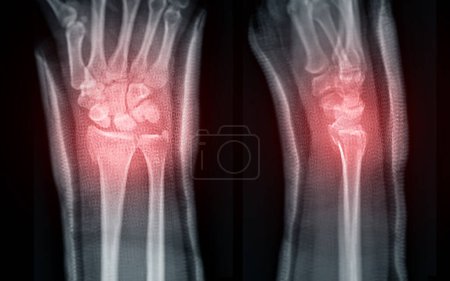 Das Röntgenbild zeigt anschaulich einen Bruch des Handgelenks und bietet eine klare visuelle Darstellung für die medizinische Diagnose und Behandlungsplanung.