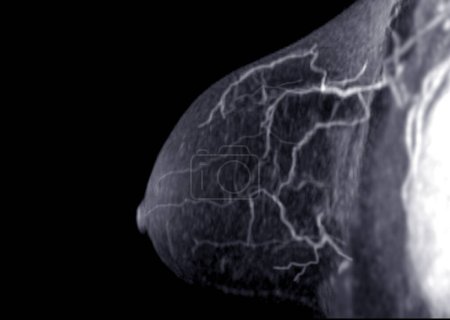 Téléchargez les photos : L'IRM mammaire révélant BI-RADS 4 chez les femmes indique des résultats suspects justifiant une investigation plus approfondie pour une éventuelle tumeur maligne et une biopsie pour confirmer la présence de lésions cancéreuses. - en image libre de droit