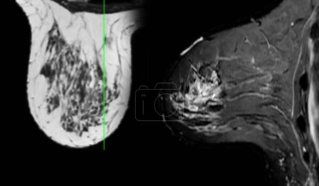 La resonancia magnética de mama que revela BI-RADS 4 en mujeres indica hallazgos sospechosos que justifican una mayor investigación de la posible malignidad y biopsia para confirmar la presencia de lesiones cancerosas.