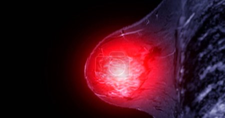 L'IRM mammaire révélant BI-RADS 4 chez les femmes indique des résultats suspects justifiant une investigation plus approfondie pour une éventuelle tumeur maligne et une biopsie pour confirmer la présence de lésions cancéreuses.