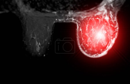 Foto de La resonancia magnética de mama que revela BI-RADS 4 en mujeres indica hallazgos sospechosos que justifican una mayor investigación de la posible malignidad y biopsia para confirmar la presencia de lesiones cancerosas. - Imagen libre de derechos