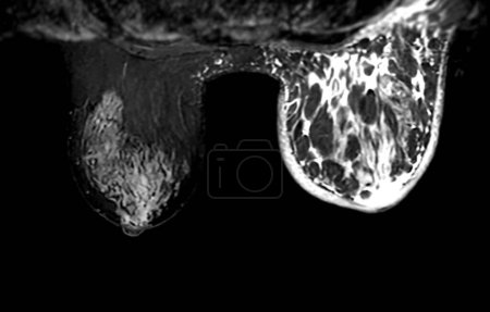Photo for Breast MRI revealing BI-RADS 4 in women indicates suspicious findings warranting further investigation for potential malignancy and  biopsy to confirm the presence of cancerous lesions. - Royalty Free Image