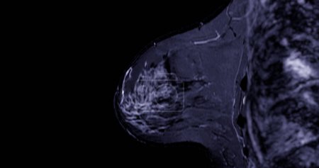 Téléchargez les photos : L'IRM mammaire révélant BI-RADS 4 chez les femmes indique des résultats suspects justifiant une investigation plus approfondie pour une éventuelle tumeur maligne et une biopsie pour confirmer la présence de lésions cancéreuses. - en image libre de droit