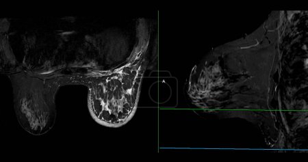 Breast MRI revealing BI-RADS 4 in women indicates suspicious findings warranting further investigation for potential malignancy and  biopsy to confirm the presence of cancerous lesions.