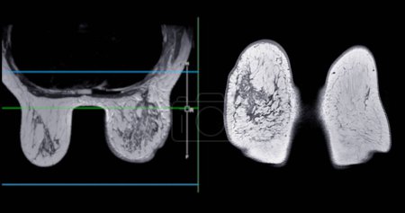 MRT der Brust, die BI-RADS 4 bei Frauen zeigt, weist auf verdächtige Befunde hin, die eine weitere Untersuchung auf mögliche bösartige Tumore und Biopsie rechtfertigen, um das Vorhandensein von Krebsläsionen zu bestätigen.