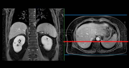 La resonancia magnética PET del hígado en el cáncer de hígado proporciona imágenes precisas, ayuda en la detección de tumores, la estadificación y la planificación del tratamiento.