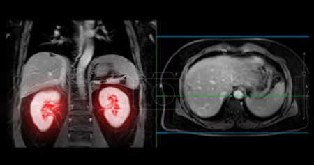 PET MRI of the liver in liver cancer provides precise imaging, aiding in tumor detection, staging, and treatment planning.