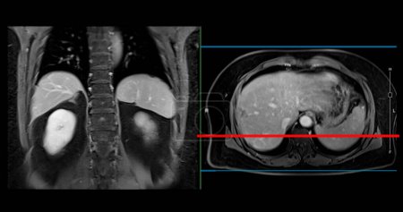 IRM PET du foie dans le cancer du foie fournit une imagerie précise, aidant à la détection des tumeurs, la mise en scène et la planification du traitement.