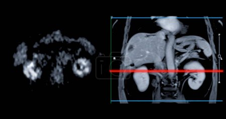 Photo for PET MRI of the liver in liver cancer provides precise imaging, aiding in tumor detection, staging, and treatment planning. - Royalty Free Image