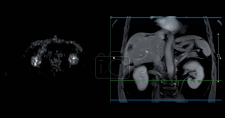 Photo for PET MRI of the liver in liver cancer provides precise imaging, aiding in tumor detection, staging, and treatment planning. - Royalty Free Image