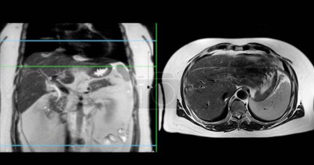 Foto de La resonancia magnética del abdomen superior es una técnica de imagen no invasiva que proporciona imágenes detalladas de órganos como el hígado, el páncreas y los riñones en caso de estudio normal.. - Imagen libre de derechos