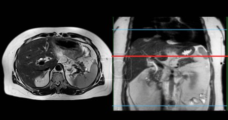 MRT des Oberbauches ist eine nicht-invasive bildgebende Technik, die detaillierte Visualisierungen von Organen wie Leber, Bauchspeicheldrüse und Nieren bei normaler Untersuchung liefert..