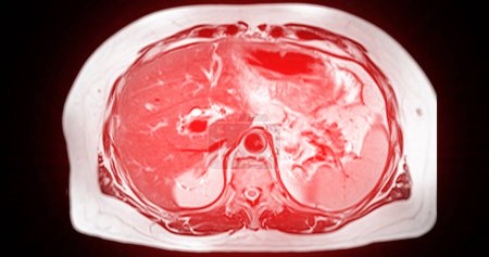 MRI of the upper abdomen  is a non-invasive imaging technique providing detailed visuals of organs like the liver, pancreas, and kidneys in case normal study.
