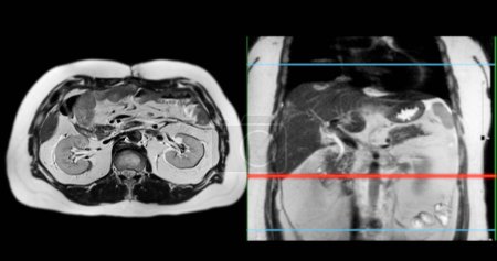 La resonancia magnética del abdomen superior es una técnica de imagen no invasiva que proporciona imágenes detalladas de órganos como el hígado, el páncreas y los riñones en caso de estudio normal..