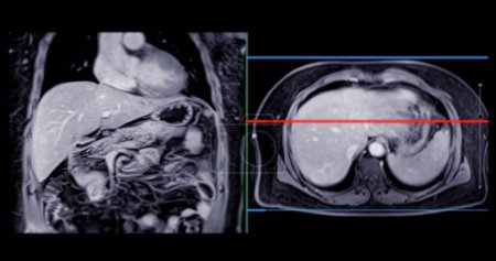 MRT des Oberbauches ist eine nicht-invasive bildgebende Technik, die detaillierte Visualisierungen von Organen wie Leber, Bauchspeicheldrüse und Nieren bei normaler Untersuchung liefert..