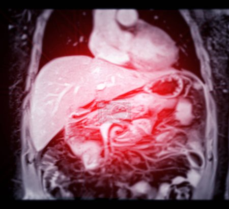 L'IRM du haut de l'abdomen est une technique d'imagerie non invasive qui fournit des images détaillées d'organes comme le foie, le pancréas et les reins dans le cas d'une étude normale..