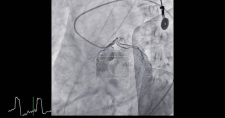 El cateterismo cardíaco es un procedimiento médico utilizado para examinar los vasos sanguíneos del corazón..