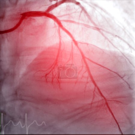 El cateterismo cardíaco es un procedimiento médico utilizado para examinar los vasos sanguíneos del corazón..