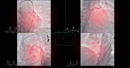 Téléchargez les photos : Cathétérisme cardiaque est une procédure médicale utilisée pour examiner les vaisseaux sanguins du cœur. - en image libre de droit
