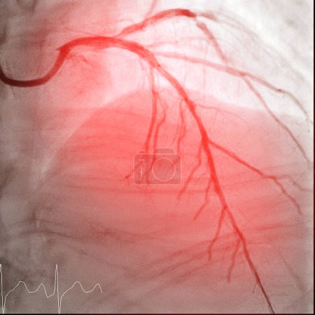 Photo for Cardiac Catheterization is a medical procedure used to examine the heart's blood vessels. - Royalty Free Image