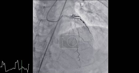 Cardiac Catheterization is a medical procedure used to examine the heart's blood vessels.