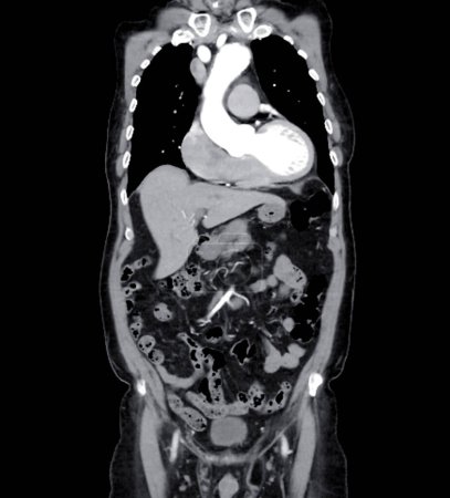 La vue coronale d'imagerie aortique entière de CTA affichant un anévrisme aortique fournit une évaluation complète pour le diagnostic précis et la planification de traitement.