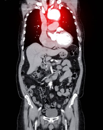 La vista coronal con imágenes de aorta completa de la ATC que muestra un aneurisma aórtico proporciona una evaluación integral para un diagnóstico preciso y una planificación del tratamiento.