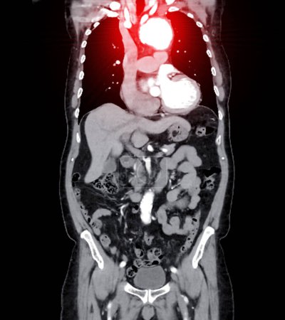 CTA ganze Aorta bildgebende koronale Ansicht der Darstellung eines Aortenaneurysmas bietet eine umfassende Bewertung für genaue Diagnose und Behandlungsplanung.