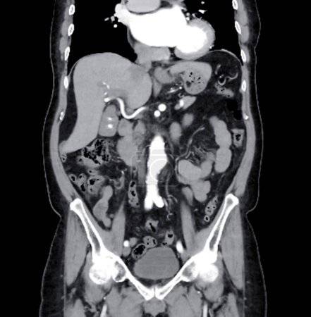  CT scan of  whole abdomen with injection contrast  media in coronal view.