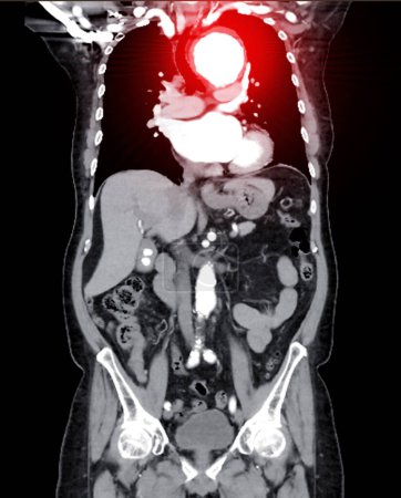 CTA whole aorta imaging coronal view displaying an aortic aneurysm provides a comprehensive evaluation for accurate diagnosis and treatment planning.
