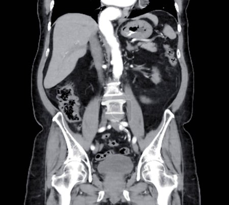  CT des ganzen Bauches mit Injektionskontrastmedien in koronaler Ansicht.