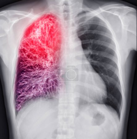 Radiographie thoracique de la poitrine humaine ou fusion pulmonaire avec scanner 3D.