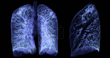 A CT chest 3D scan displaying a lesion at the right upper lobe offers a detailed visualization, aiding in precise identification and  treatment planning.