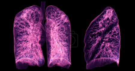 Photo for A CT chest 3D scan displaying a lesion at the right upper lobe offers a detailed visualization, aiding in precise identification and  treatment planning. - Royalty Free Image