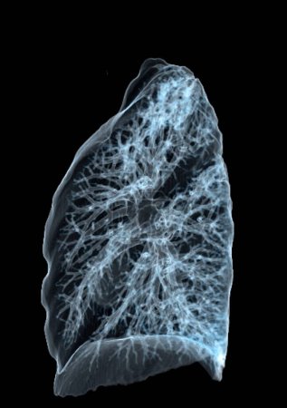 CT Chest or Lung 3d rendering image  showing Trachea and lung in respiratory system.	