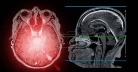 IRM plan sagittal de balayage du cerveau pour détecter les maladies cérébrales subies comme les accidents vasculaires cérébraux, tumeurs cérébrales et infections.