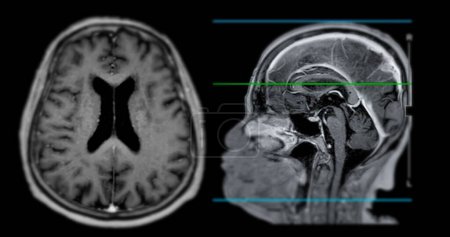 MRT Gehirn-Scan sagittale Ebene zur Erkennung von Gehirnerkrankungen sush als Schlaganfallerkrankung, Hirntumoren und Infektionen.