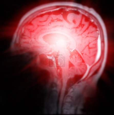 Resonancia magnética del cerebro escaneo sagital plano para detectar enfermedades cerebrales sush como enfermedad cerebrovascular, tumores cerebrales e infecciones.