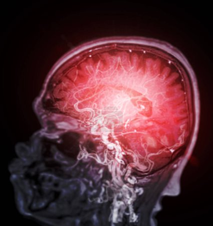 MRT Gehirn-Scan sagittale Ebene zur Erkennung von Gehirnerkrankungen sush als Schlaganfallerkrankung, Hirntumoren und Infektionen.
