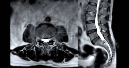 RM L-S columna vertebral o columna lumbar Técnica axial y sagital T2 con línea de referencia para el diagnóstico de compresión medular.