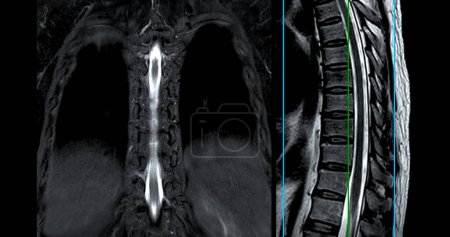 MRT T-L Wirbelsäule oder Thorakosakrale Wirbelsäule Axiale und sagittale T2-Technik mit Referenzlinie für die Diagnose Rückenmarkskompression.
