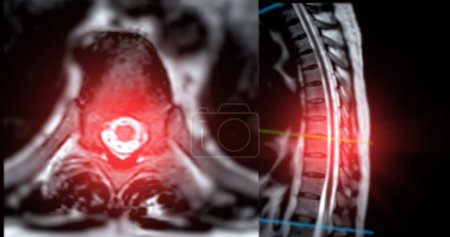 MRT T-L Wirbelsäule oder Thorakosakrale Wirbelsäule Axiale und sagittale T2-Technik mit Referenzlinie für die Diagnose Rückenmarkskompression.