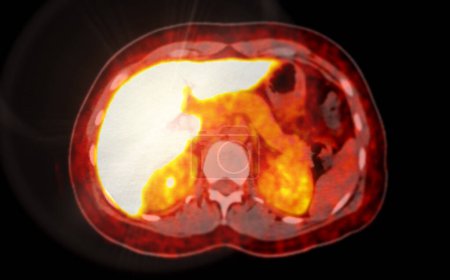 Une image de TEP-TDM est une visualisation diagnostique combinant la tomographie par émission de positrons (TEP) et la tomodensitométrie (TDM) pour aider à trouver la récurrence du cancer.