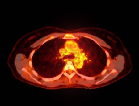 A PET-CT scan image is a diagnostic visualization combining Positron Emission Tomography (PET) and Computed Tomography (CT) for Helps in finding cancer recurrence.