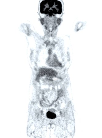 Ein PET-CT-Scan-Bild ist eine diagnostische Visualisierung, die Positronen-Emissions-Tomographie (PET) und Computertomographie (CT) kombiniert, um ein Rezidiv von Krebs zu finden..