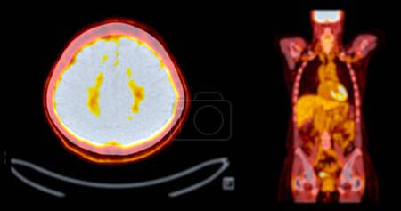 Ein PET-CT-Scan-Bild ist eine diagnostische Visualisierung, die Positronen-Emissions-Tomographie (PET) und Computertomographie (CT) kombiniert, um ein Rezidiv von Krebs zu finden..