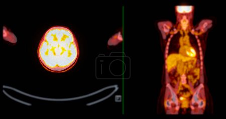 Photo for A PET-CT scan image is a diagnostic visualization combining Positron Emission Tomography (PET) and Computed Tomography (CT) for Helps in finding cancer recurrence. - Royalty Free Image